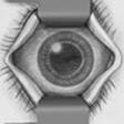 cataract
