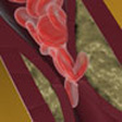 clot