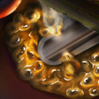 lobectomy